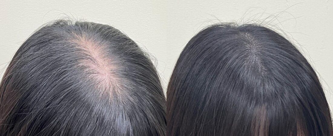 가르마가 넓어졌을 때, 초기에 확인하고 대응하는 방법