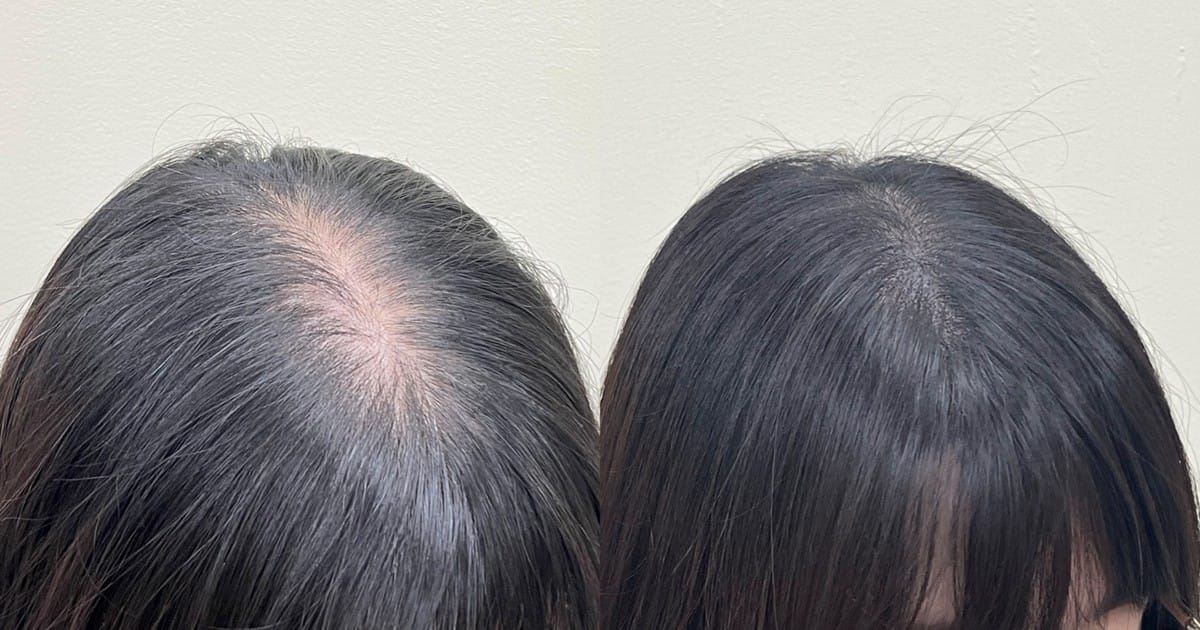 가르마탈모, 정말 탈모일까? 원인과 구분 기준 5가지