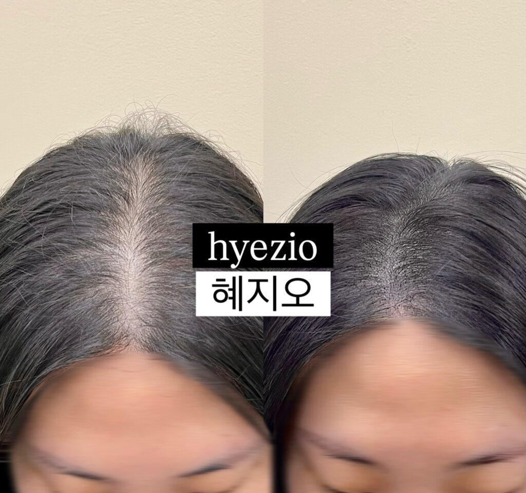 여성 앞머리 헤어라인과 가르마 두피문신 시술 전후 비교