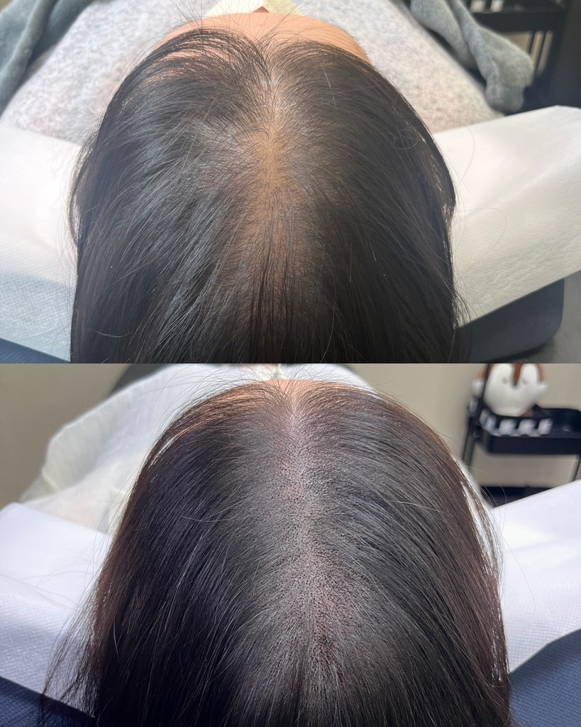 누운 자세에서 본 여성 가르마 두피문신 전후 비교, 가르마 주변 밀도 변화