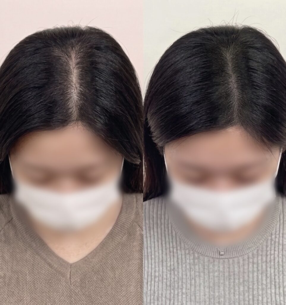 중요한 일정을 앞두고 진행한 가르마 부위 전후 비교