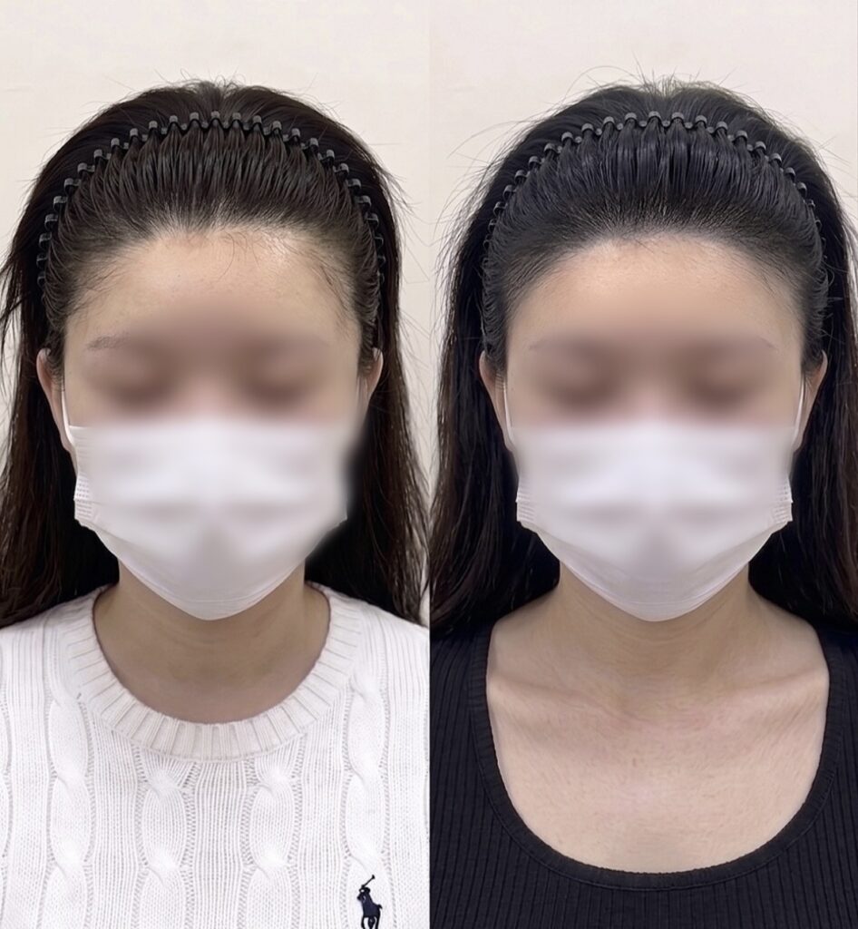 헤어라인 두피문신 시술 전후 비교