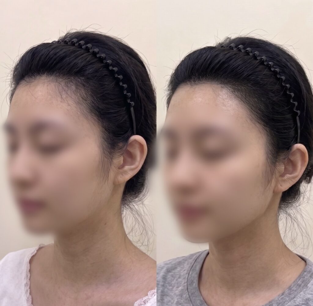 측면에서 본 여성 헤어라인 두피문신 전후 비교