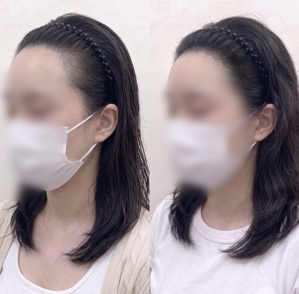 얼굴형에 맞춰 정돈한 헤어라인 두피문신 전후