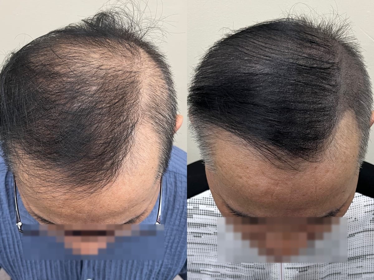 남성 정수리 두피문신 비포애프터