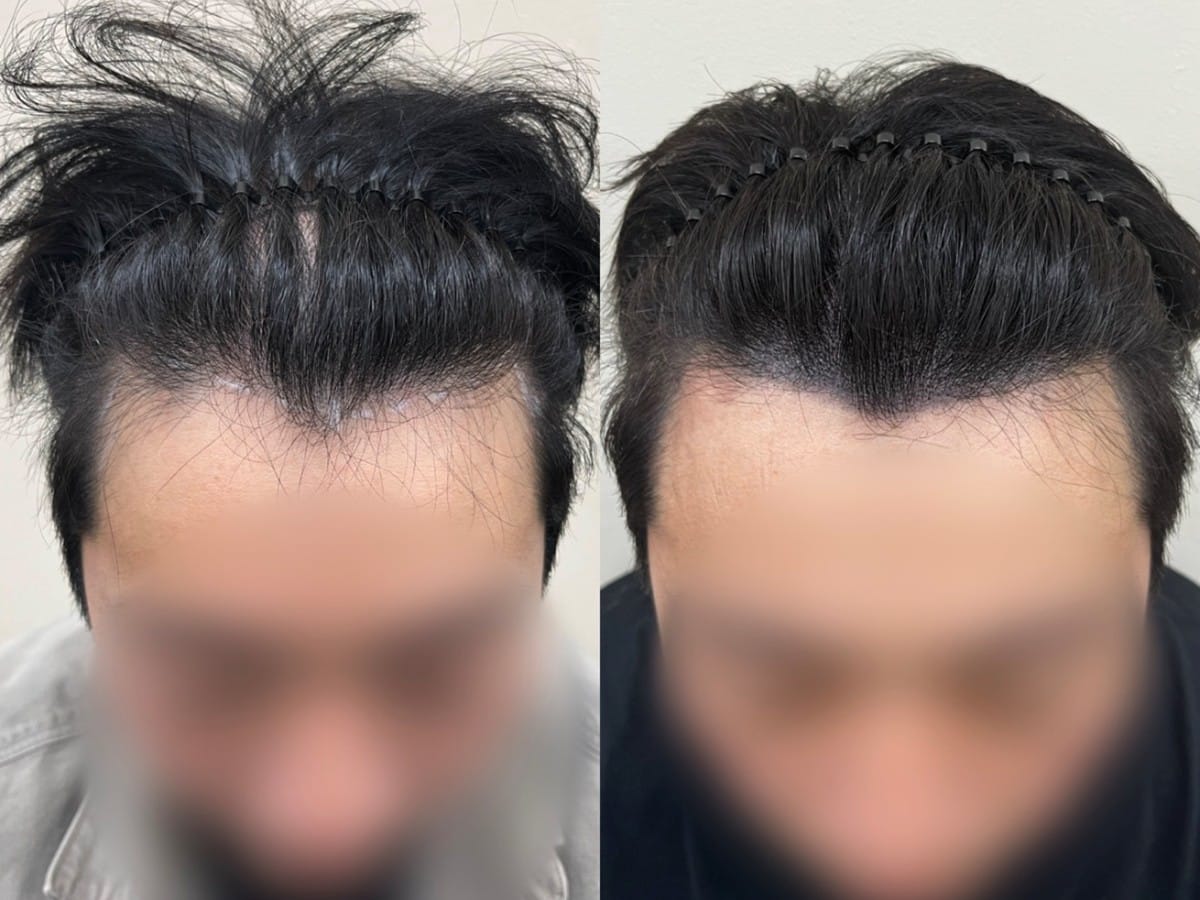 남성 헤어라인 두피문신 비포애프터