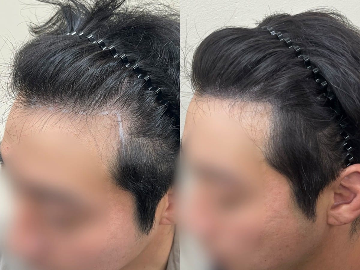 남성 헤어라인 두피문신 비포애프터