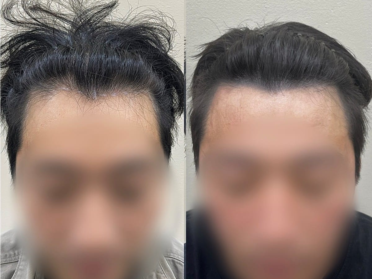 남성 헤어라인 두피문신 비포애프터
