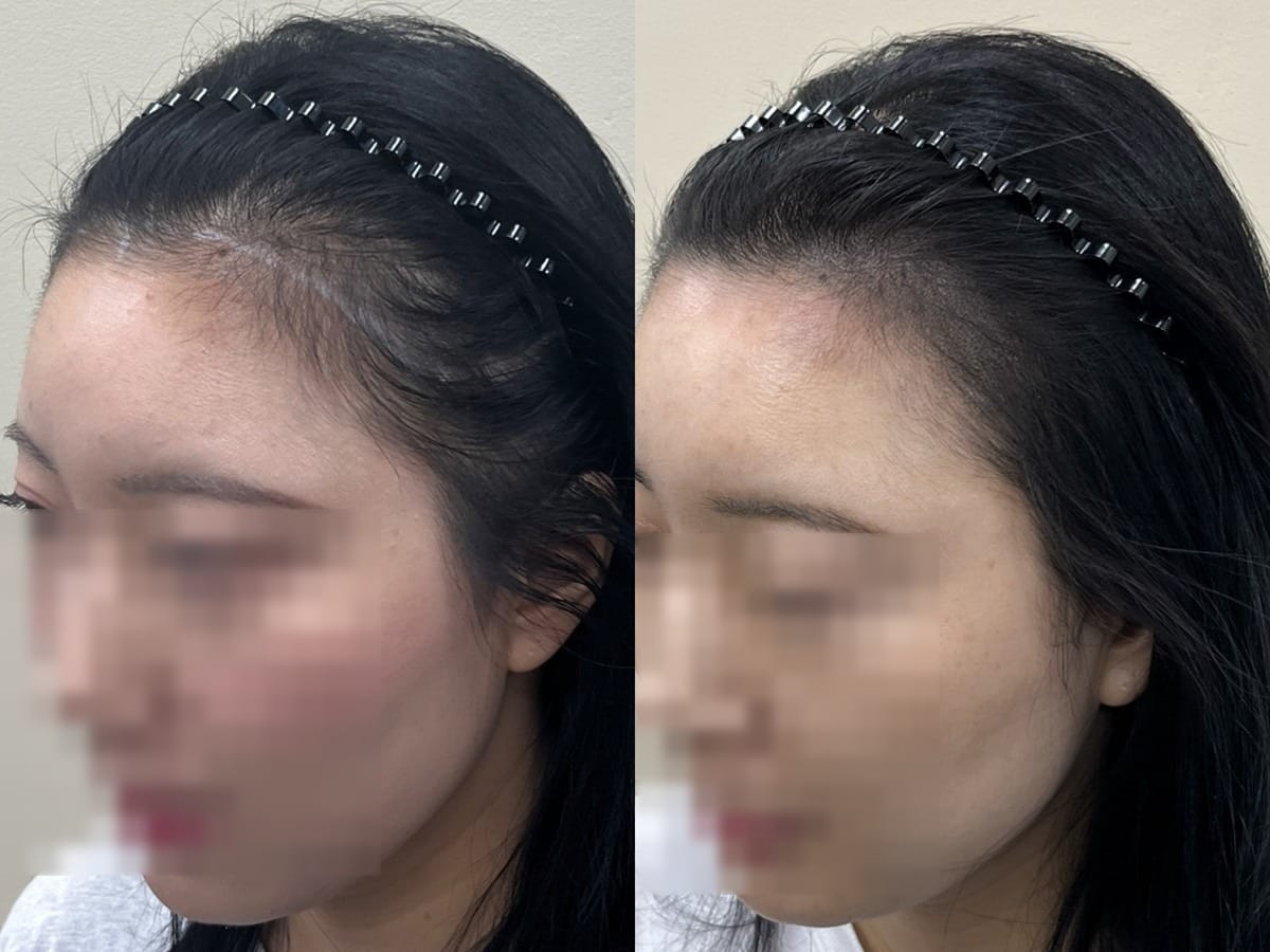 여성 헤어라인 두피문신 비포애프터