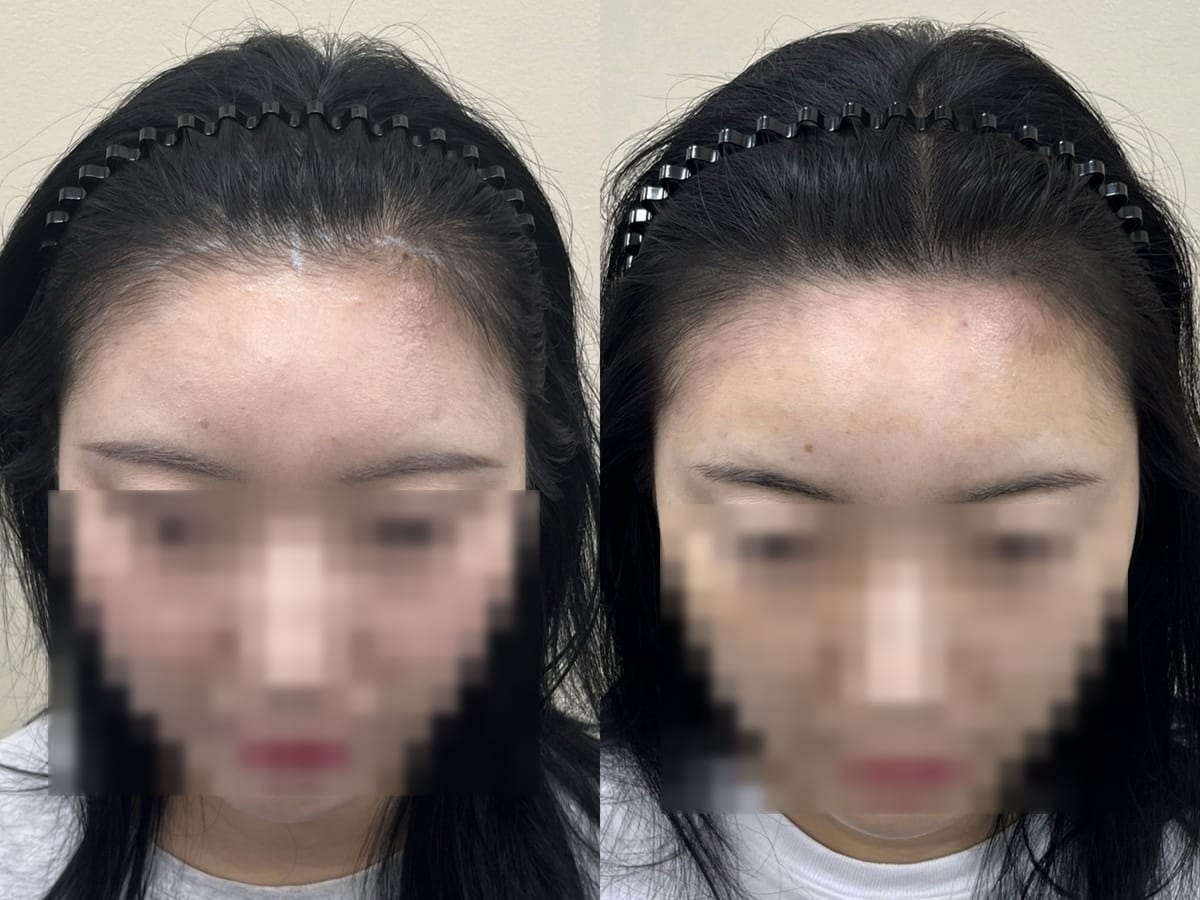 여성 헤어라인 두피문신 비포애프터