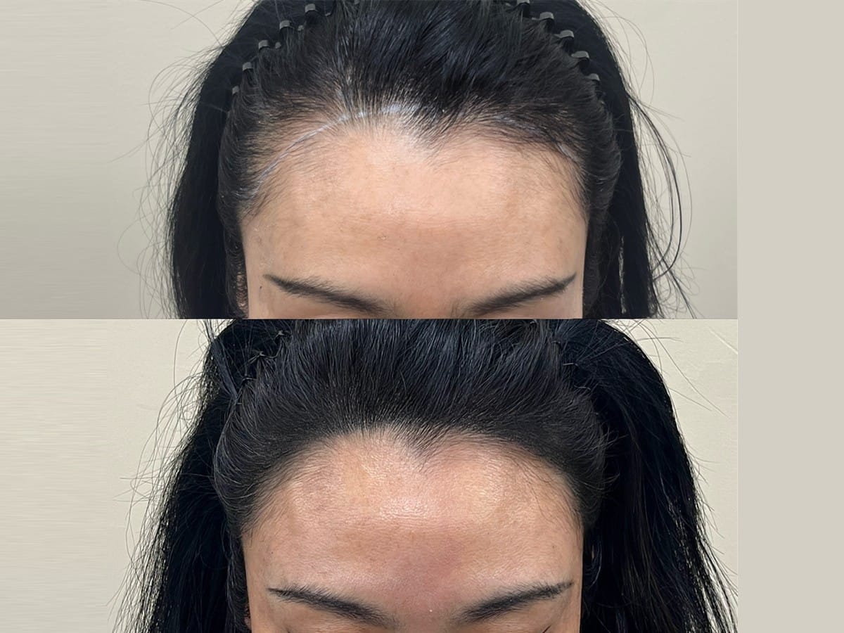 여성 헤어라인 두피문신 비포애프터