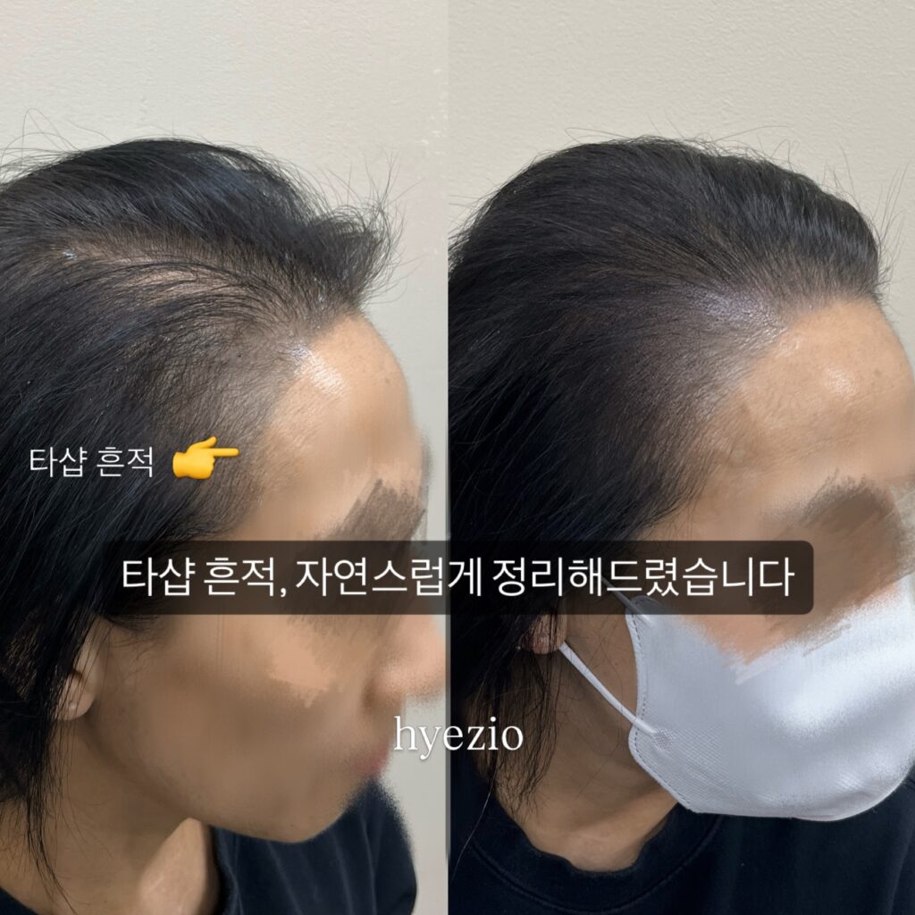 다른 곳에서 받은 헤어라인 시술 흔적을 자연스럽게 정리한 전후 비교