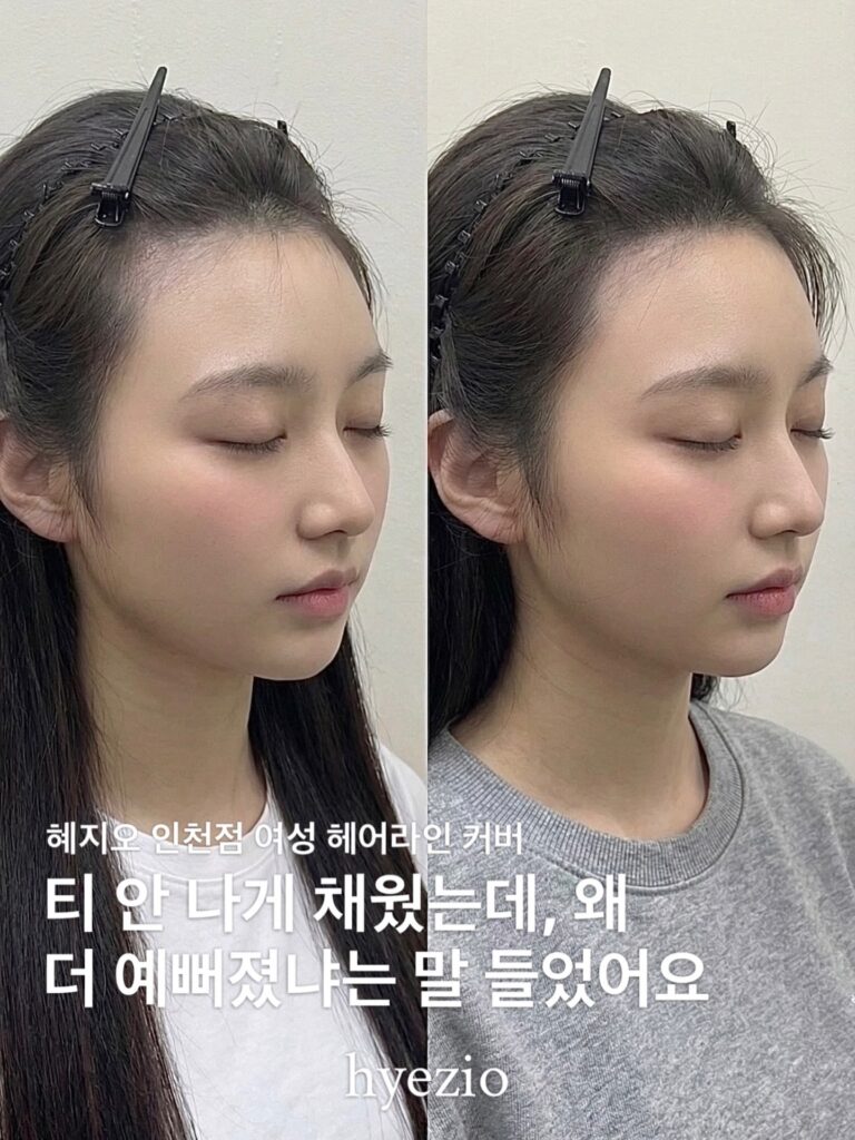 여성 헤어라인 커버 시술 전후 비교와 고객 후기 문구가 담긴 이미지
