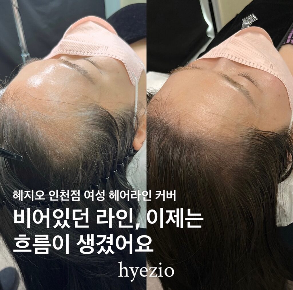 여성 헤어라인 두피문신 시술 전후 비교, 누운 자세에서 본 라인 흐름