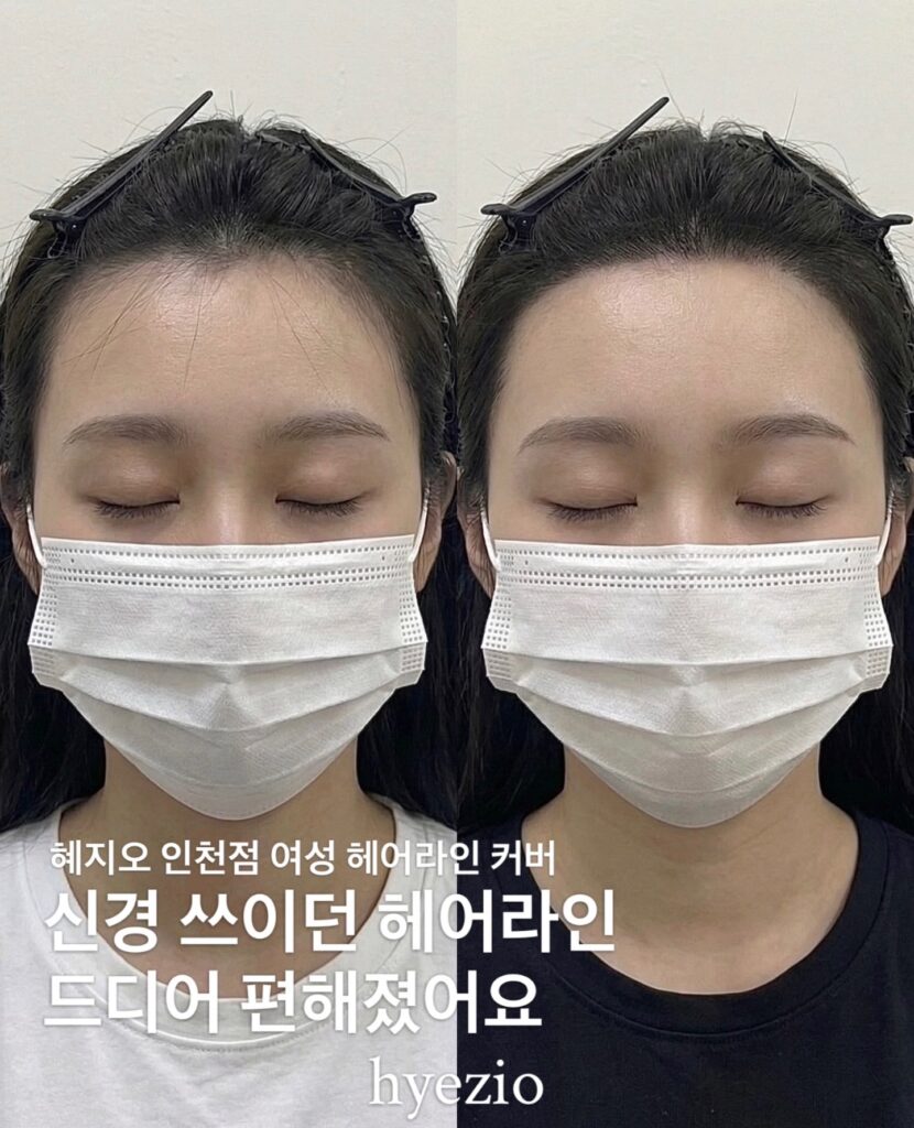 여성 헤어라인 두피문신 시술 전후 비교, 마스크 착용 정면