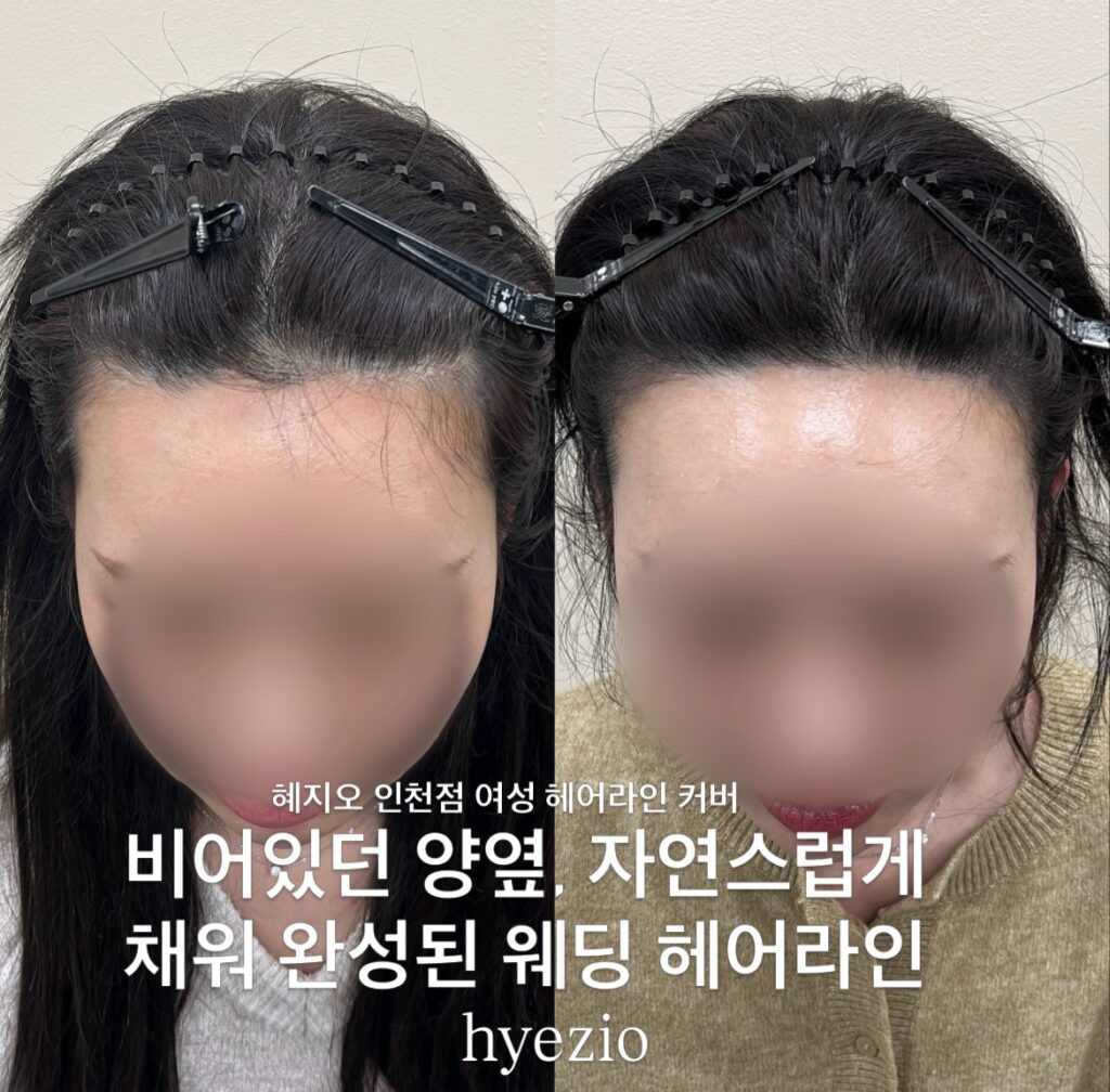웨딩 헤어라인 두피문신 시술 전후 비교, 양옆 헤어라인을 채운 결과