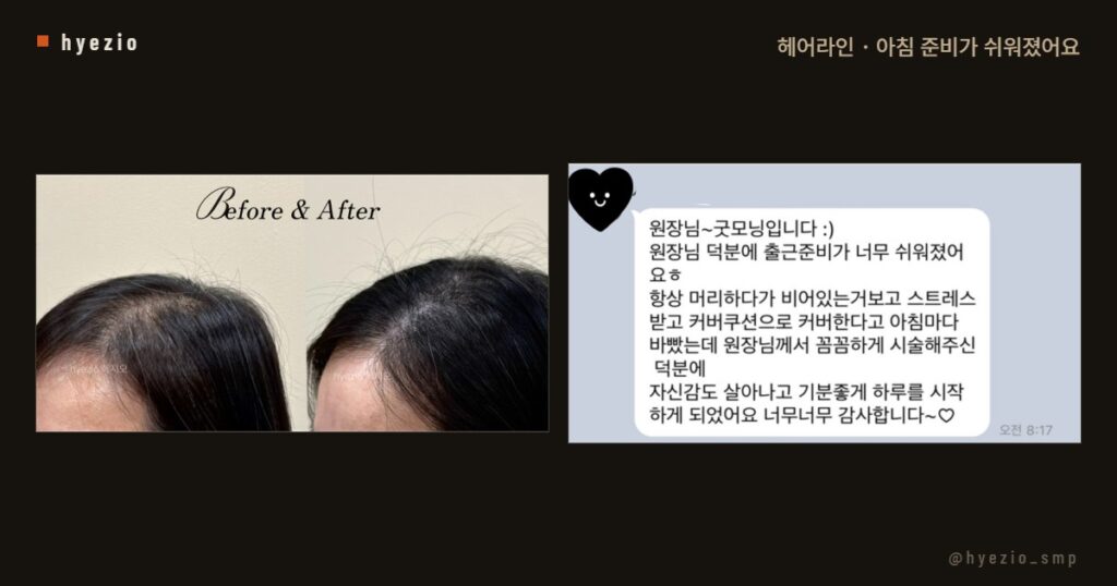 헤어라인 시술 뒤 아침 준비가 쉬워졌다는 고객 후기와 전후 사진