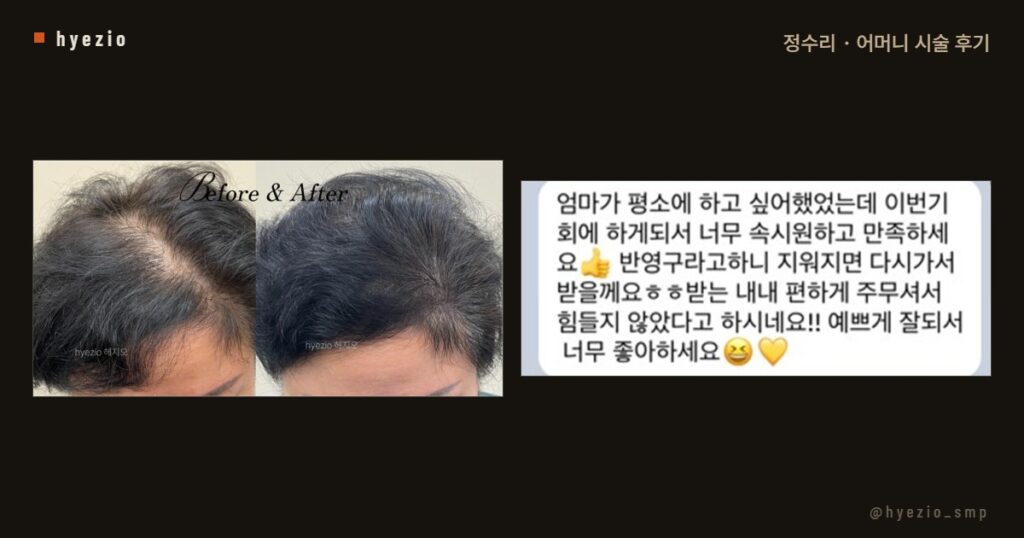 어머니 정수리 시술 후 가족이 남긴 후기와 전후 사진
