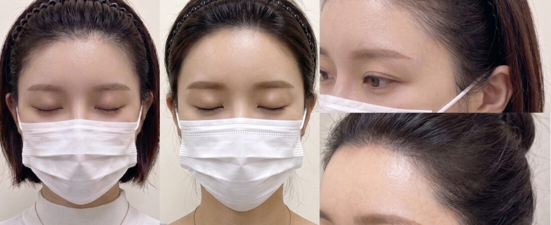 여성 헤어라인 두피문신, 자연스러운 결과를 만드는 기준
