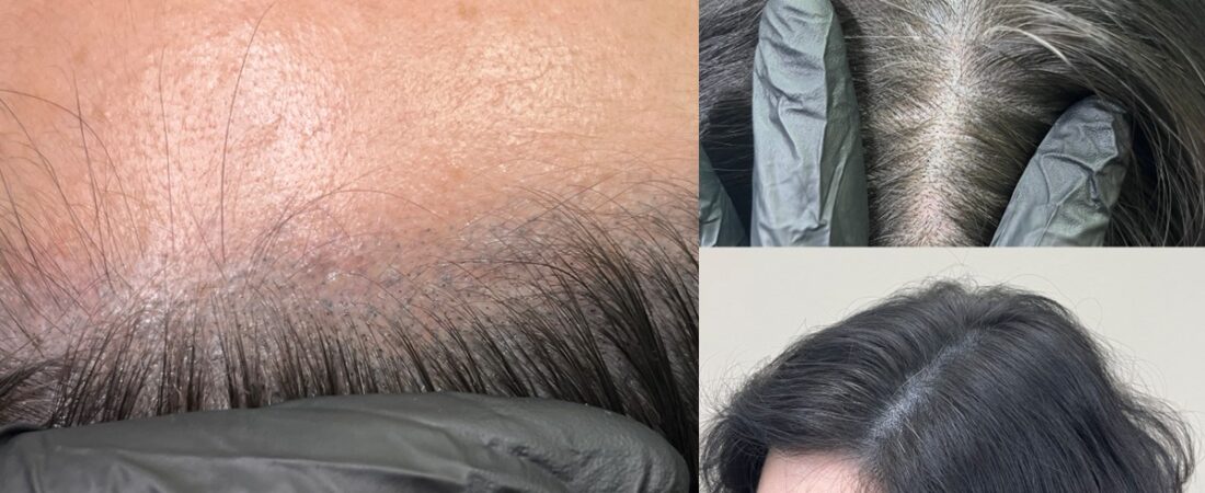 두피문신 잘못되면 평생 안 지워질까, 미리 알아야 할 것들