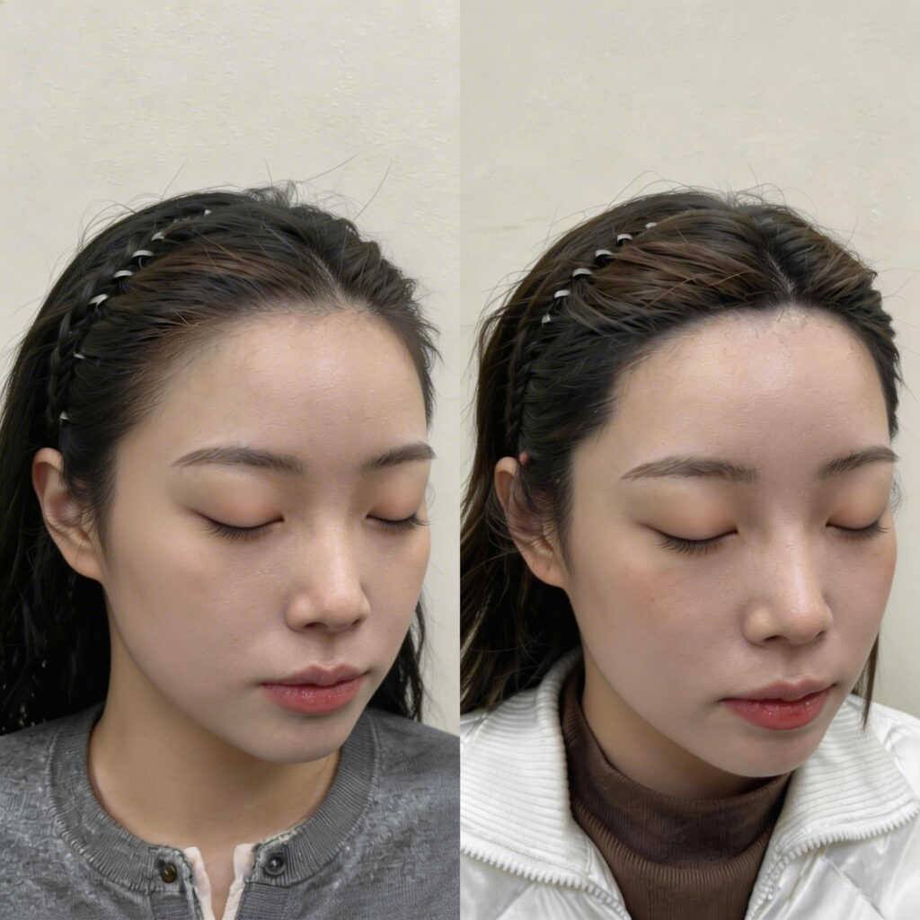 여성 헤어라인 두피문신 시술 전후 비교, 정면