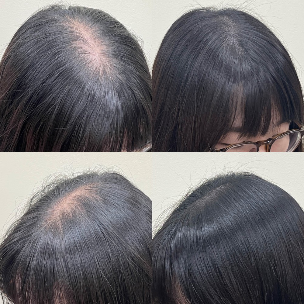 여성 정수리 두피문신 전후 비교, 네 각도에서 본 가마 주변 밀도 변화