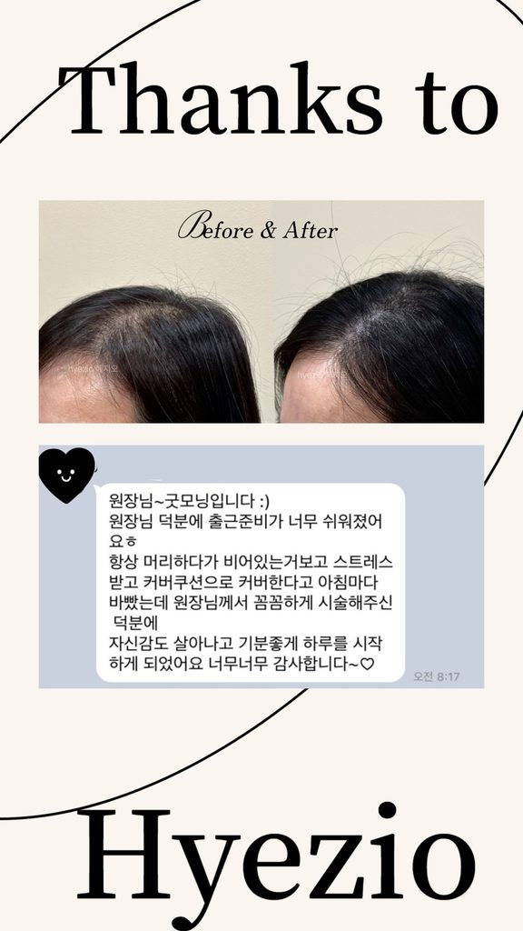 이마 잔머리 헤어라인 두피문신 전후 사진과 카카오톡 후기가 담긴 고객 후기 이미지