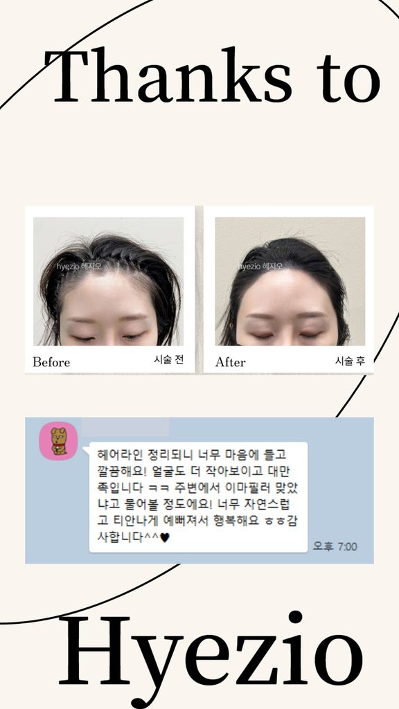 헤어라인 두피문신 전후 비교 사진과 자연스러웠다는 카카오톡 후기 이미지