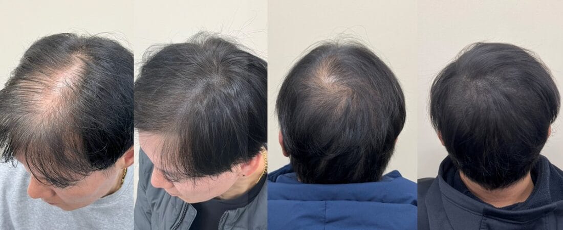 정수리 두피문신 잘하는 곳은 무엇이 다를까요?