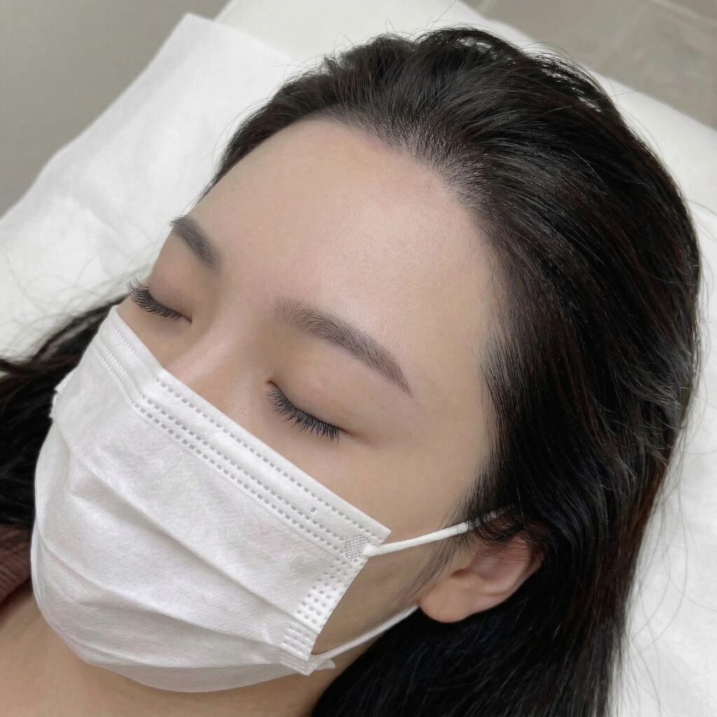 시술대에 누운 상태에서 촬영한 여성 헤어라인 근접 사진