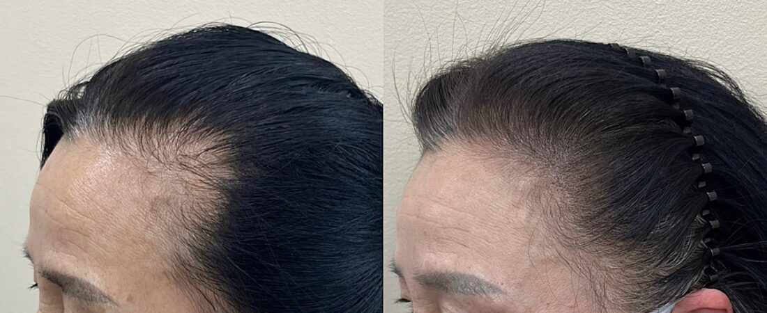 앞머리탈모, 정말 탈모일까? 비어 보이는 이유와 구분 기준 5가지