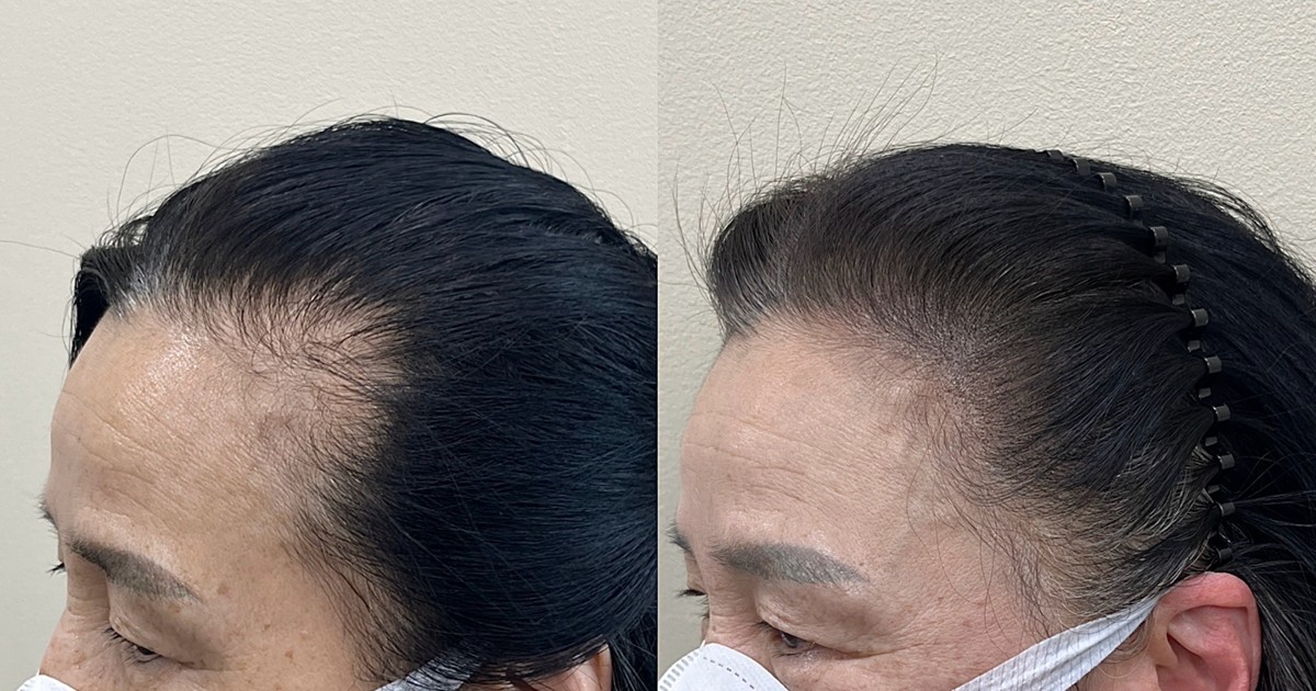 앞머리탈모, 정말 탈모일까? 비어 보이는 이유와 구분 기준 5가지