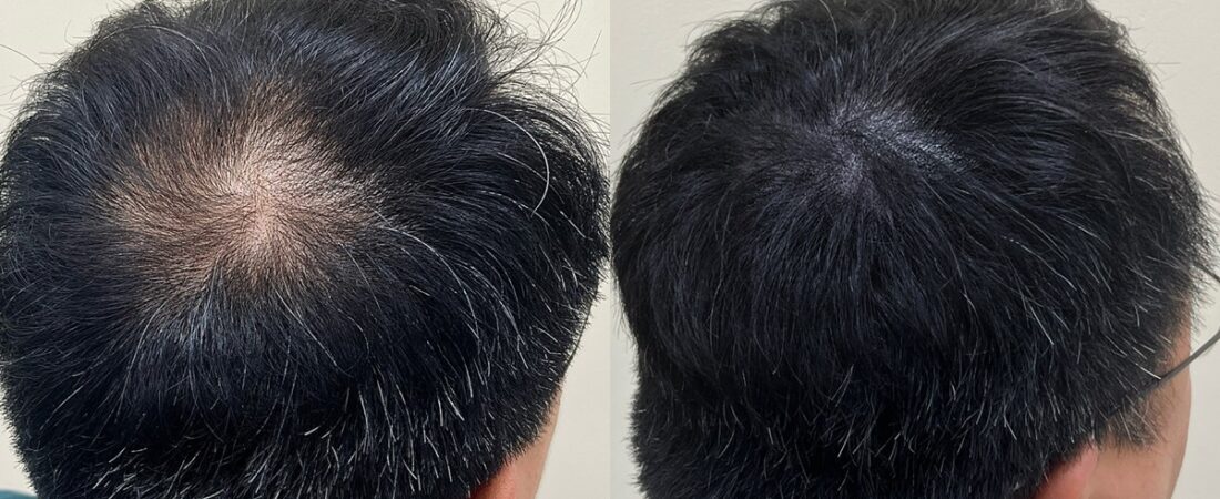 남자정수리탈모, 가마 때문일까? 탈모인지 확인하는 기준부터 관리 방법까지