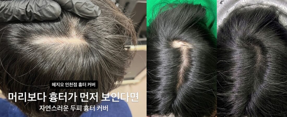 이마축소술·모발이식 흉터, 두피문신으로 자연스럽게 가리기