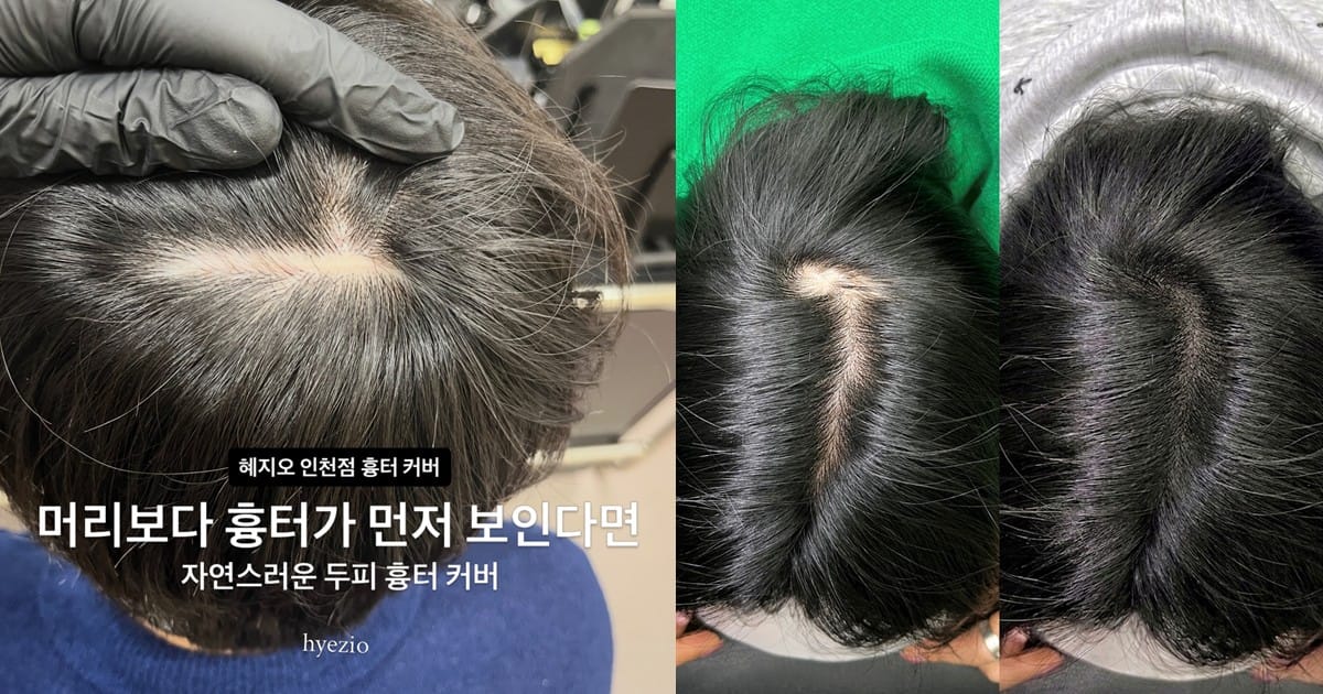 흉터커버, 내 두피 흉터도 가능할까? 시술 전 꼭 확인할 기준