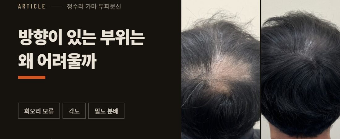 정수리 가마 두피문신, 방향이 있는 부위는 왜 어려울까