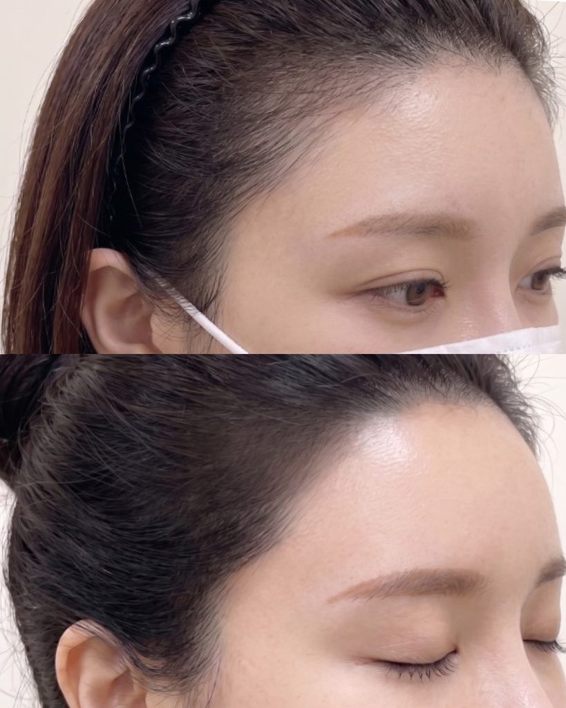 여성 헤어라인 두피문신 전후 측면 비교, 이마 라인이 정돈된 모습