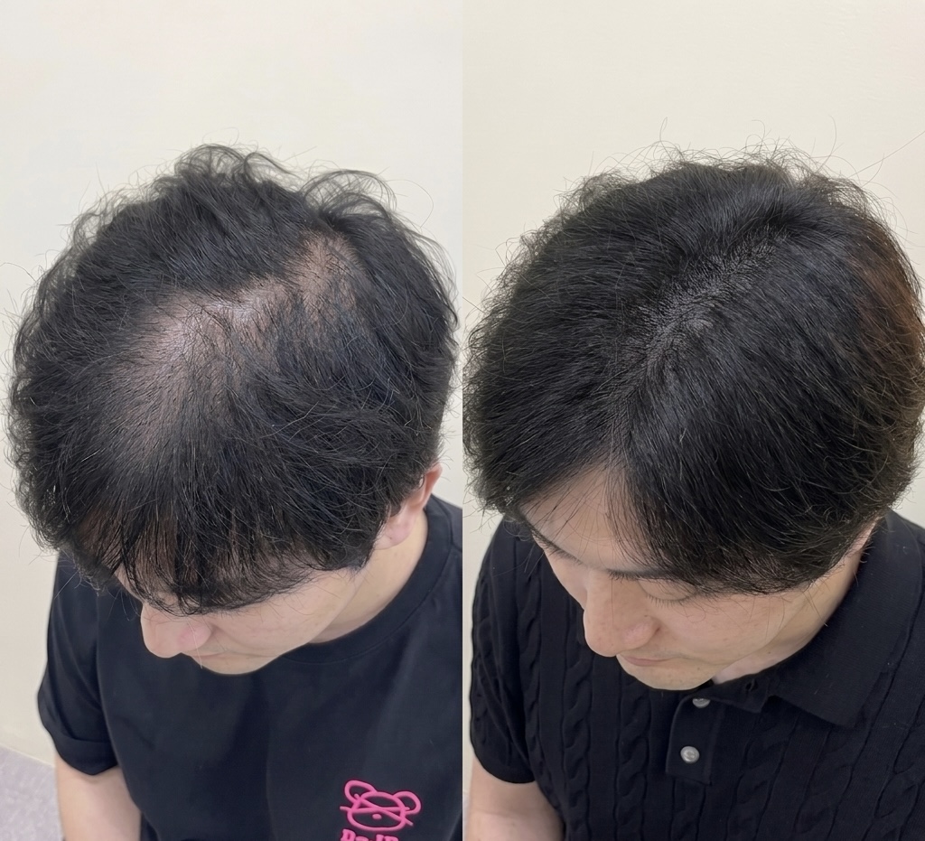 두피문신 시술 전후 헤어라인 비교, 비어 보이던 앞머리가 채워진 모습
