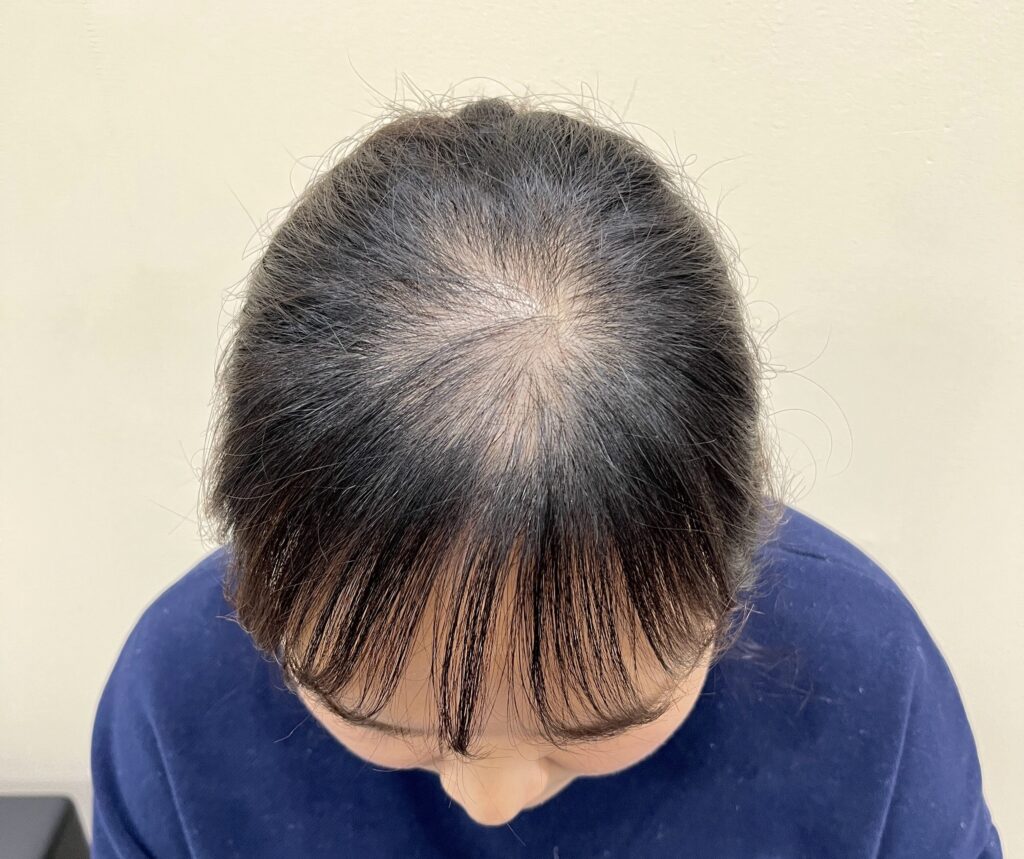 여자정수리탈모로 긴 머리 사이 정수리 두피가 비쳐 보이는 모습