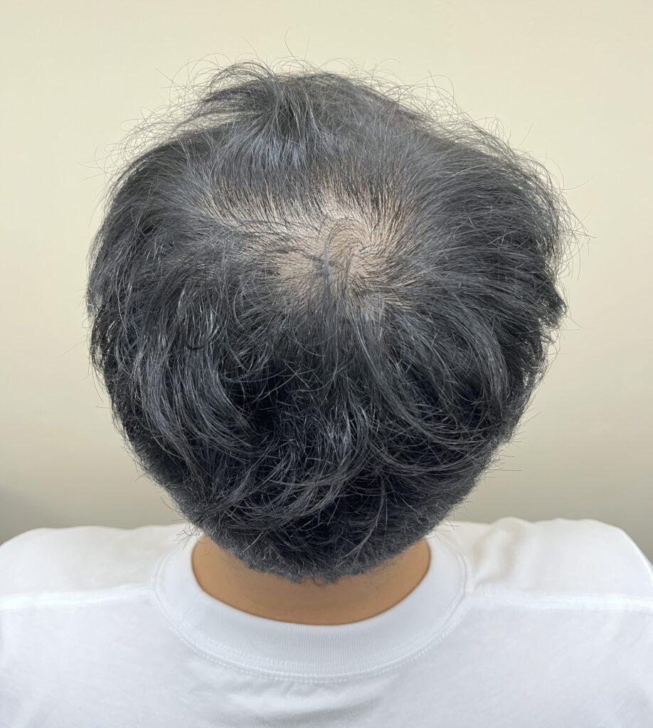 뒤에서 본 정수리, 가마 중심이 드러나 비어 보이는 시술 전 상태