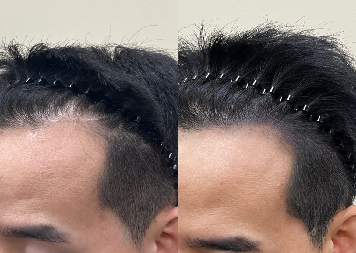 리터치 전후 헤어라인 밀도 비교