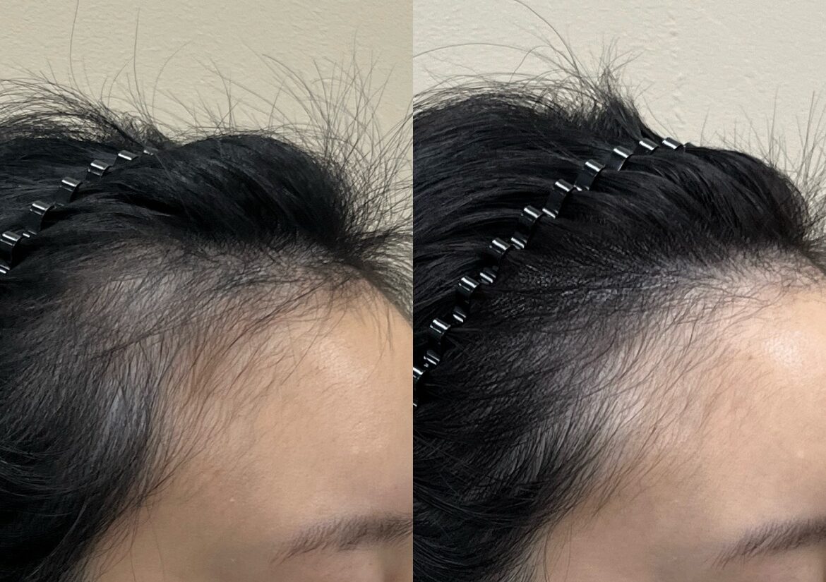 여성 앞머리탈모 헤어라인 근접 전후 비교, 잔머리와 경계 표현의 차이