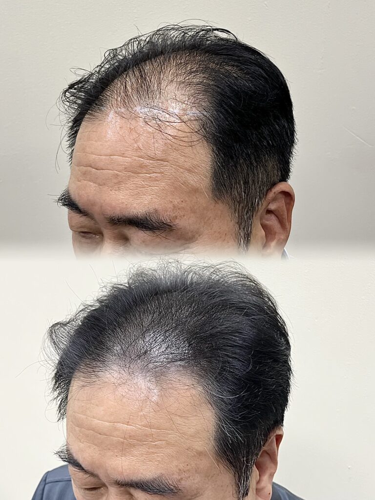 모근이 거의 없던 앞쪽 헤어라인과 정수리를 두피문신으로 커버한 50대 남성 사례
