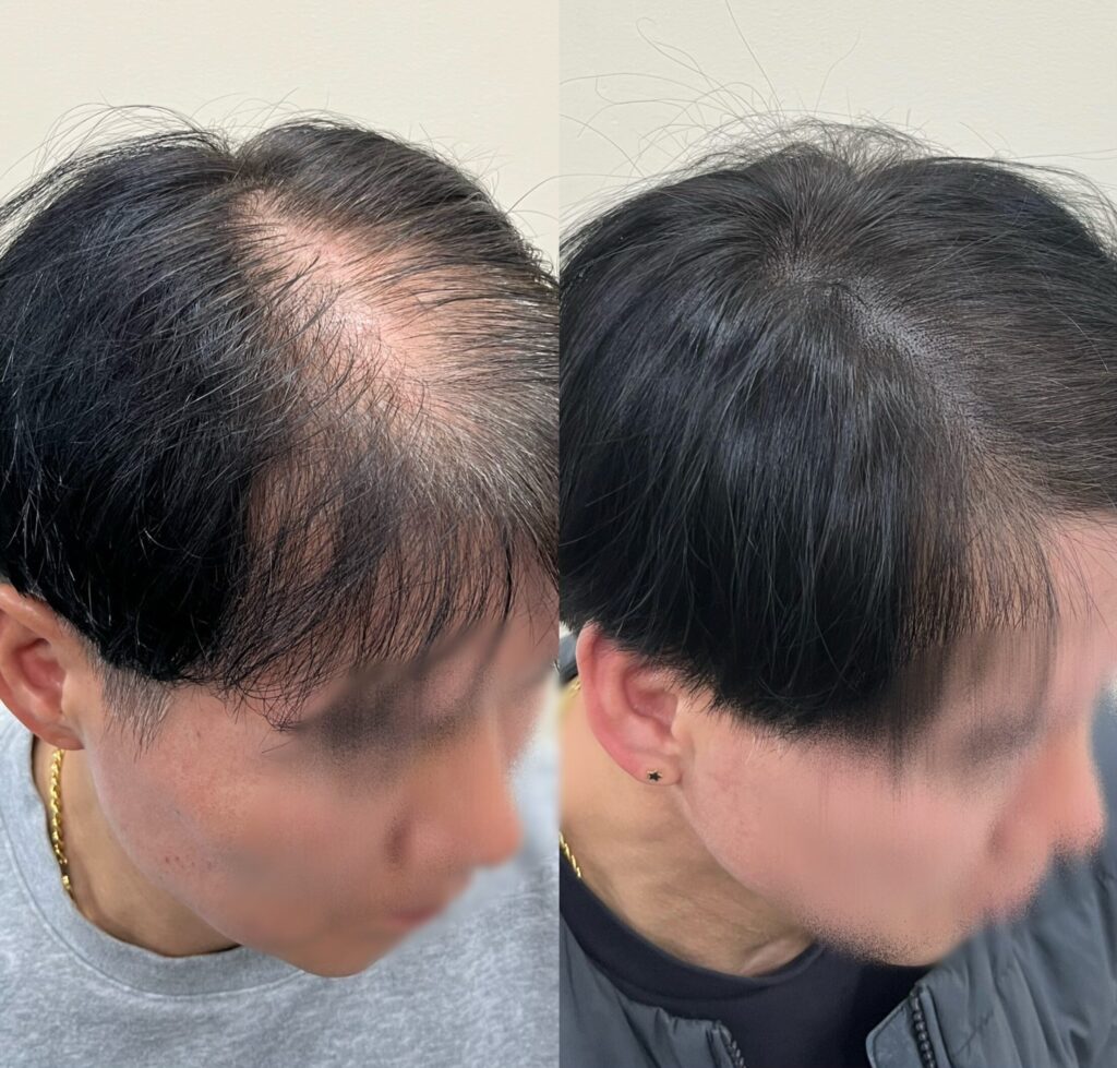 옆에서 본 정수리 전후, 가르마에서 가마로 이어지는 라인 변화
