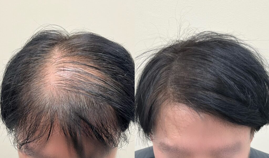 남성 정수리두피문신 전후 비교, 위에서 내려다본 가마 주변 밀도 변화