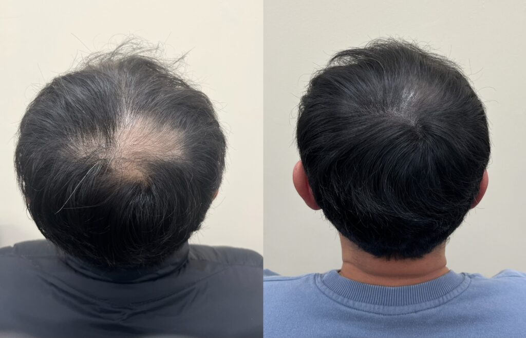 뒤에서 봤을 때 원형으로 비어 보이던 남성 정수리, 두피문신 전후 비교