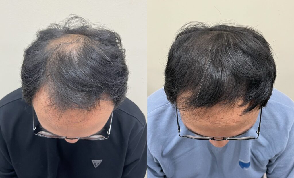 정수리 밀도를 시각적으로 채운 두피문신 전후