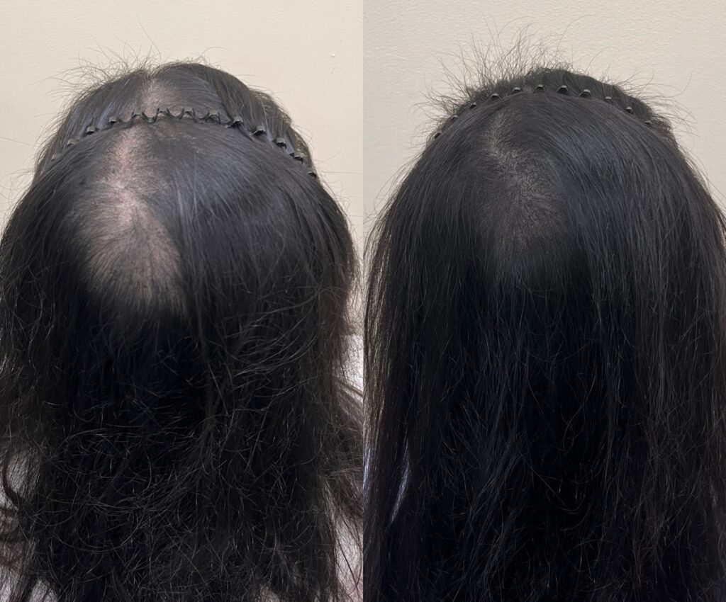 뒤에서 본 정수리 전후 비교, 넓어 보이던 면이 채워진 모습