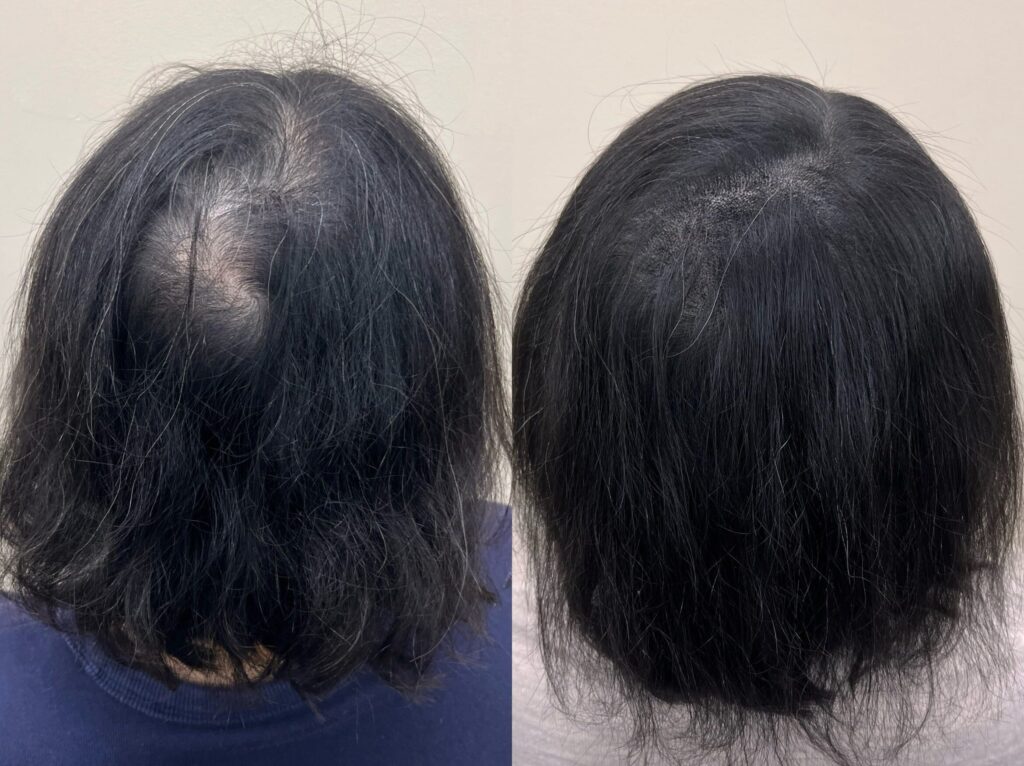 여성 정수리 두피문신 전후 비교