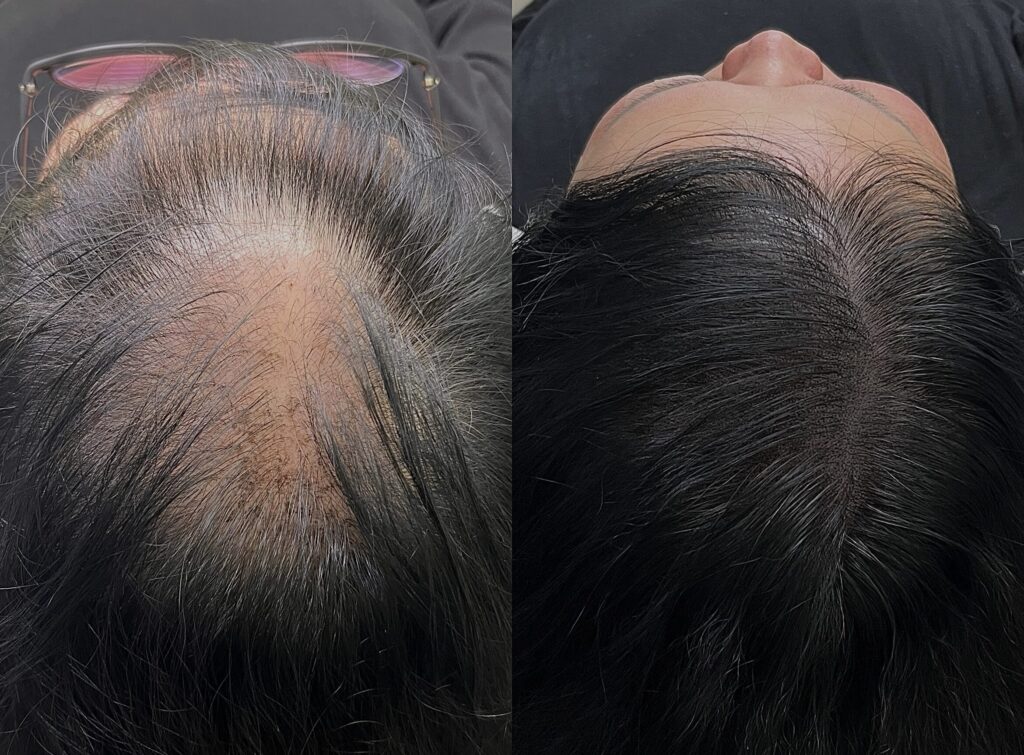 여성 가르마·정수리 두피문신 전후 비교, 누운 자세에서 본 가르마 주변 밀도